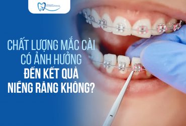Chất lượng mắc cài có ảnh hưởng đến kết quả niềng răng không?