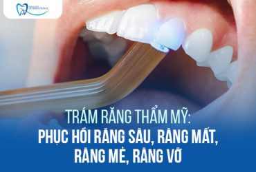 Trám răng thẩm mỹ: Phục hồi răng sâu, răng mất, răng mẻ, răng vỡ